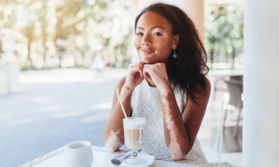 El vitiligo, una enfermedad de la piel muy compleja