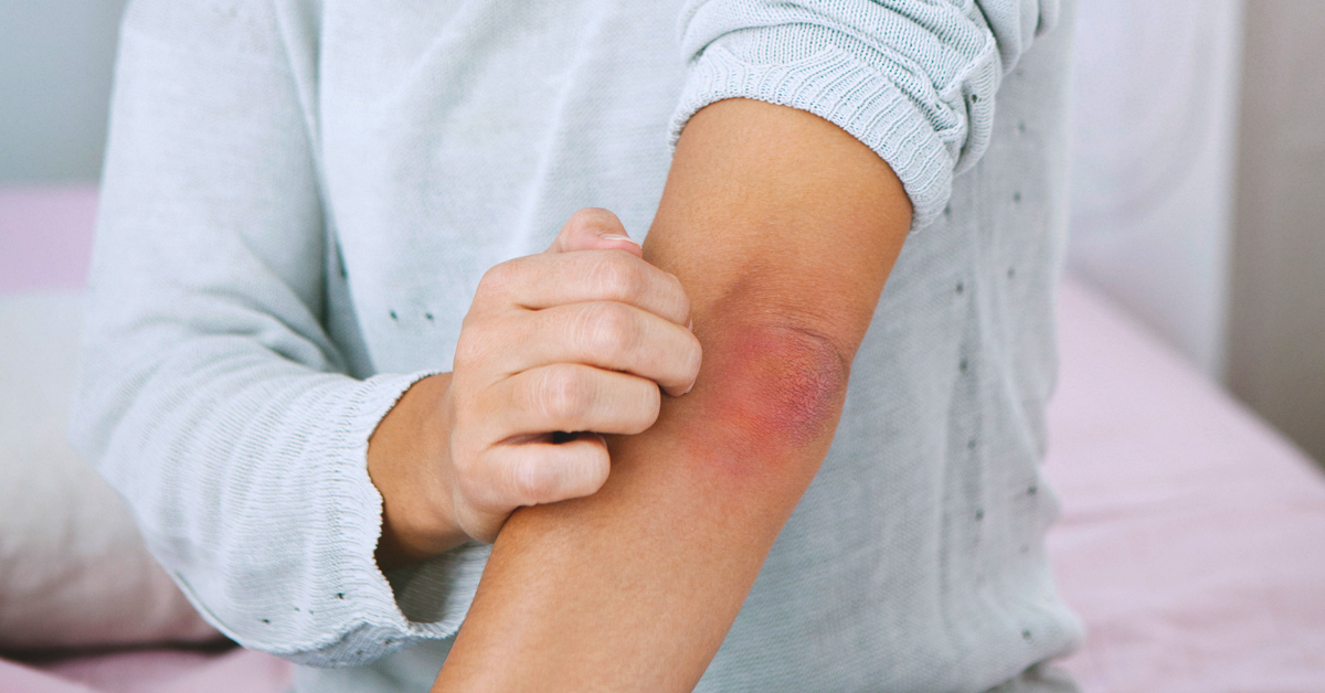 29 de octubre: Día Internacional de la Psoriasis