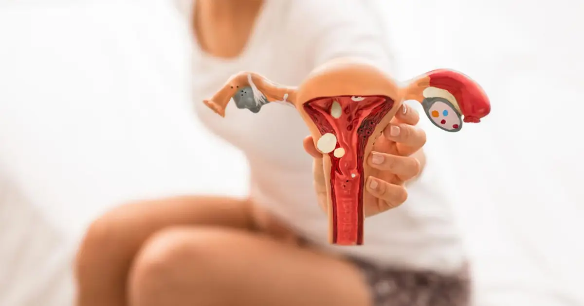 La endometriosis afecta a 1 de cada 10 mujeres en edad reproductiva