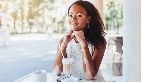 25 de junio: Día Mundial del Vitiligo